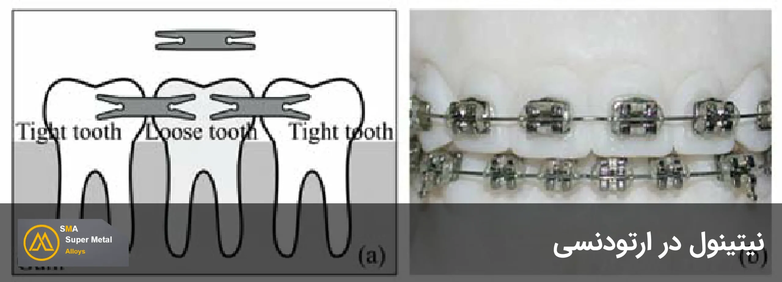 نیتینول در ارتودنسی-2