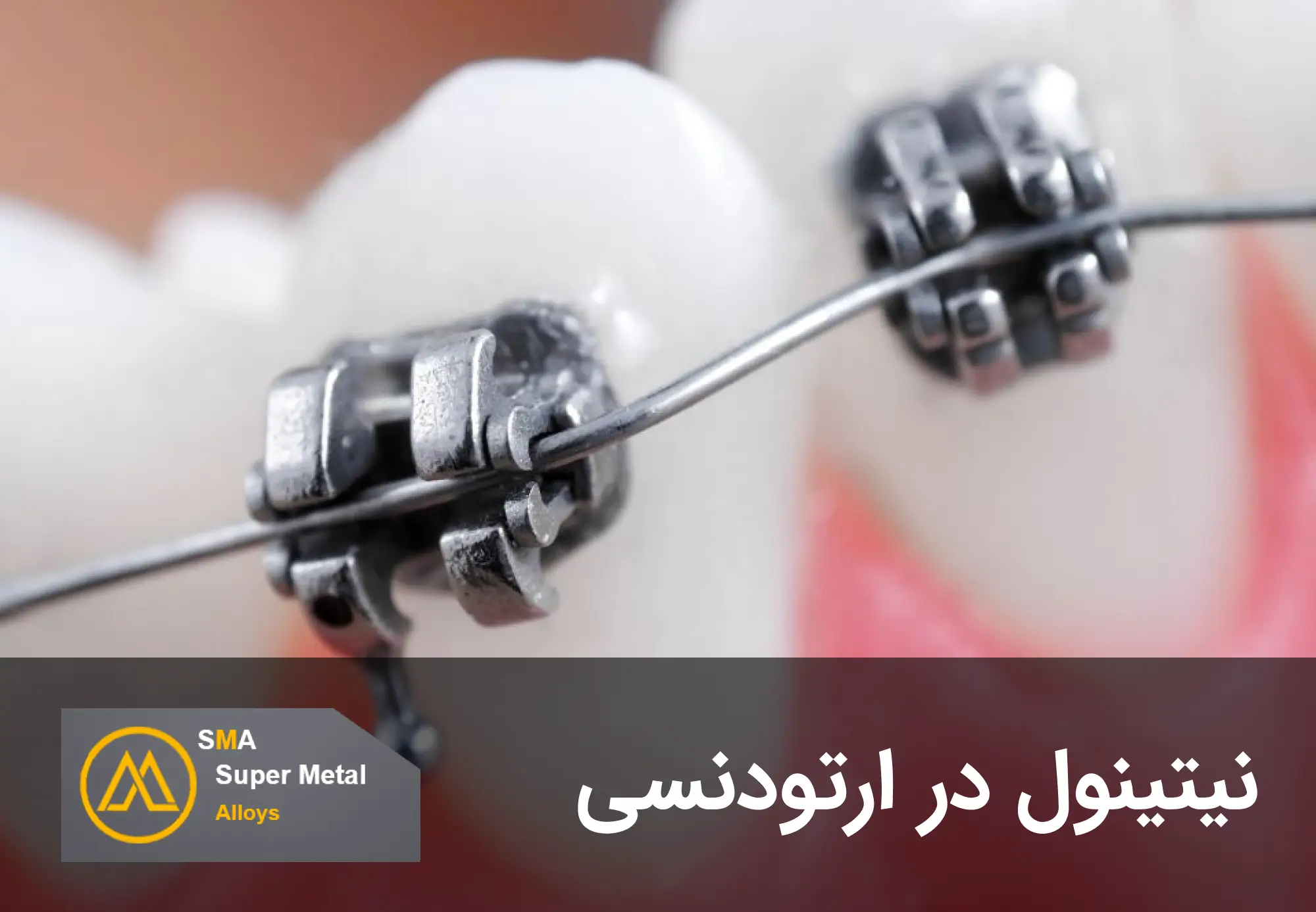 نیتینول در ارتودنسی